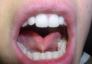 frein de langue allaitement